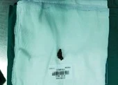 Mảnh đạn 40 năm nằm trong ổ bụng tạo ổ áp xe khổng lồ