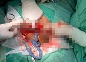 Báo động đỏ cứu bé gái thai suy vì dây rốn thắt nút