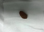 Bé trai suýt chết vì hạt xí muội lọt vào phế quản