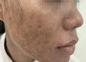 Trẻ hóa da bằng laser: Coi chừng già và xấu hơn!
