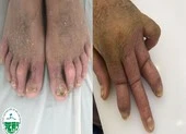 Biến dạng khớp vì tìm thầy lang chữa bệnh vảy nến