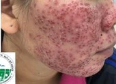 Mặt tiền tan nát, vỡ mộng trắng sáng vì lột da bằng hóa chất