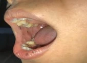 Phát hiện bệnh hiếm từ miệng có nhiều nốt sậm màu
