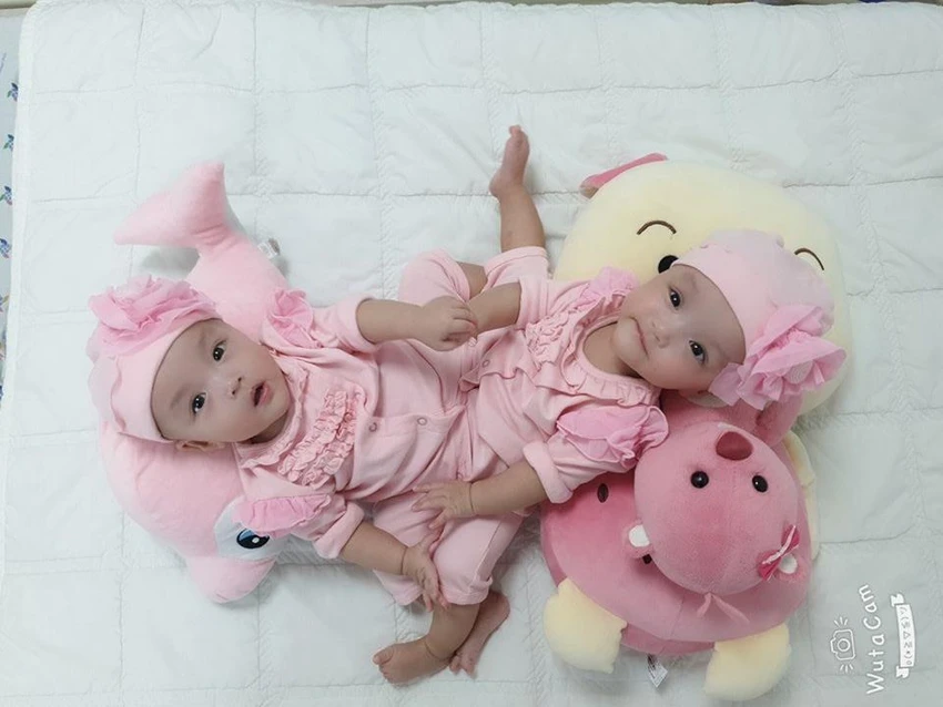 Ca mổ tách song sinh: Dị tật phù hợp dự liệu trước phẫu thuật ảnh 4 Ca mổ tách song sinh: Dị tật phù hợp dự liệu trước phẫu thuật ảnh 4