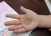 Chân tay trẻ có dát nâu đen, cha mẹ chớ coi thường