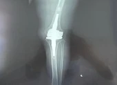 Đặt khớp gối titanium từ Đức về Việt Nam để chữa cho bệnh nhân