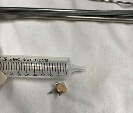 Dị vật răng giả có móc sắt được các bác sĩ gắp ra. Ảnh: BVCC Dị vật răng giả có móc sắt được các bác sĩ gắp ra. Ảnh: BVCC