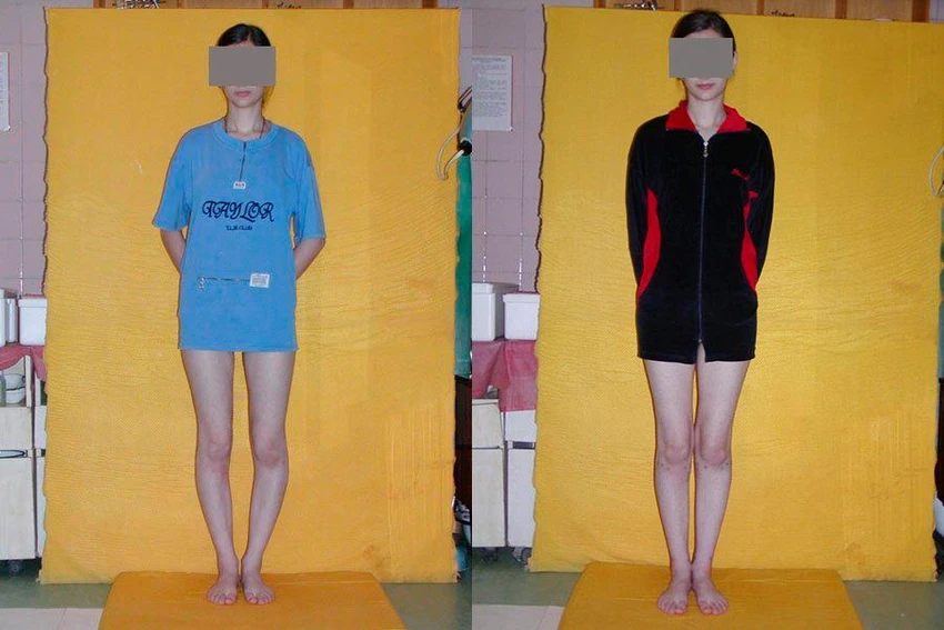 Người có chân vòng kiềng trước và sau khi được cân chỉnh. Ảnh: BSCC Người có chân vòng kiềng trước và sau khi được cân chỉnh. Ảnh: BSCC