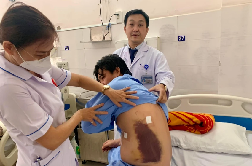 Vết thương và bầm tím ở hông tài xế xe ôm công nghệ do vật lộn với tên cướp. Ảnh: HL Vết thương và bầm tím ở hông tài xế xe ôm công nghệ do vật lộn với tên cướp. Ảnh: HL