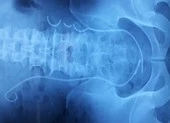 Ống JJ đứt làm 3 bị 'bỏ quên' trong niệu quản suốt 3 năm