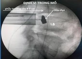 Lấy thành công đầu đạn 51 năm nằm trong cơ thể