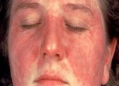 Lupus ban đỏ nguy hiểm như thế nào?