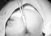 Hóc xương cá lóc 5 ngày, cổ họng bé gái đầy ổ áp xe