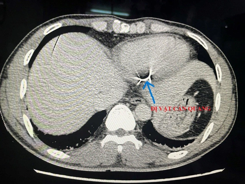 Hình ảnh chụp cắt lớp phát hiện dị vật trong tim bệnh nhân. Ảnh: BVCC Hình ảnh chụp cắt lớp phát hiện dị vật trong tim bệnh nhân. Ảnh: BVCC