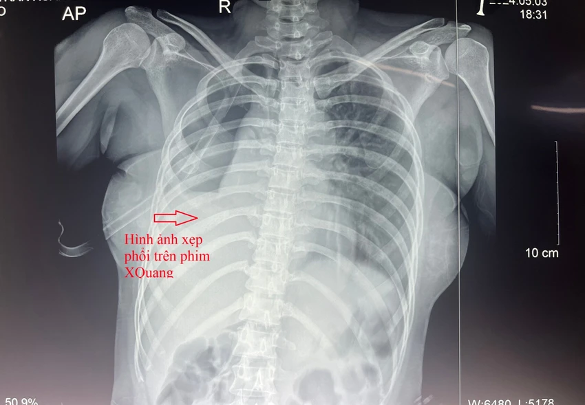 đứt phế quản