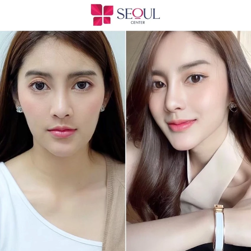 Seoul Center là địa chỉ tiêm filler an toàn và uy tín Seoul Center là địa chỉ tiêm filler an toàn và uy tín