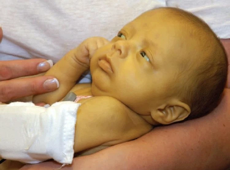 Vàng da là một trong những biểu hiện của người mắc viêm gan. Ảnh: MOTHERHOOD CARE Vàng da là một trong những biểu hiện của người mắc viêm gan. Ảnh: MOTHERHOOD CARE