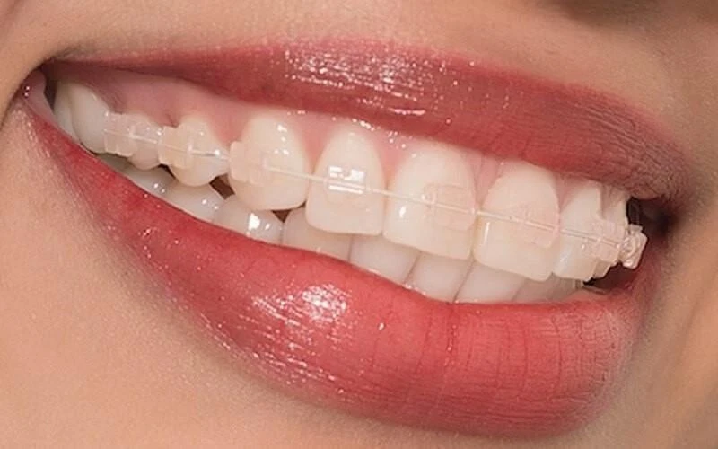 Những ưu điểm vượt trội của phương pháp niềng răng mắc cài sứ