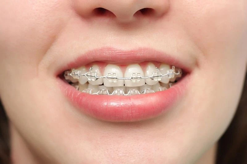Giá niềng răng mắc cài sứ phụ thuộc vào nhiều yếu tố