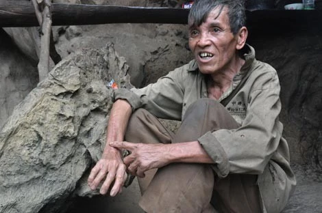 Ông Toán chỉ vào vết sẹo trong lần bị rắn cắn. Ông Toán chỉ vào vết sẹo trong lần bị rắn cắn.