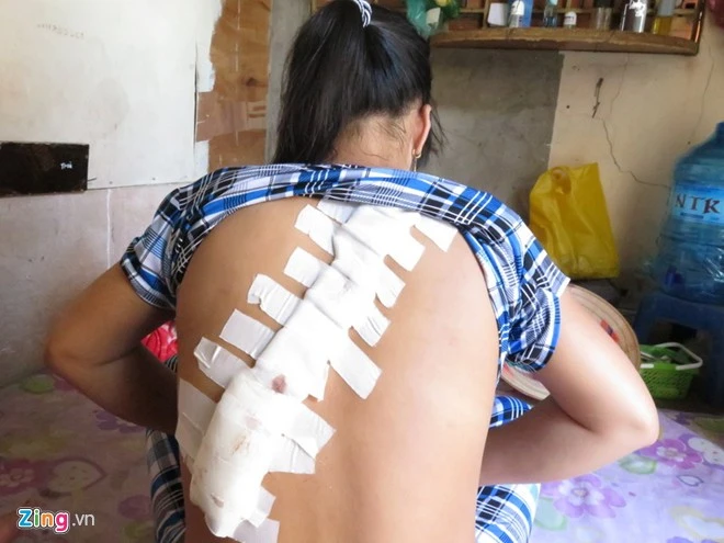 Vết thương trên lưng chị My. Nhập mô tả cho ảnh