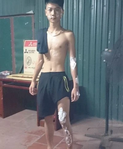 Một người đi đường bị bỏng do a xít trong xe tải bắn ra ngoài. Một người đi đường bị bỏng do a xít trong xe tải bắn ra ngoài.