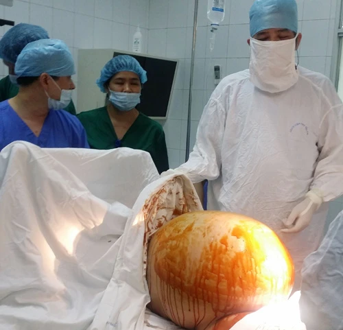 Phẫu thuật lấy khối u khỏi cơ thể người phụ nữ