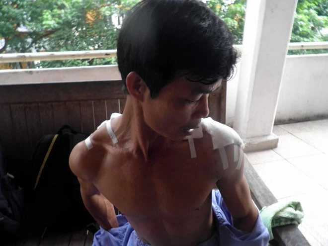 Nạn nhân Hải đang điều trị tại bệnh viện Viêt Nam- Thụy Điển tại Uông Bí với vết thương khoảng chục mũi. Nạn nhân Hải đang điều trị tại bệnh viện Viêt Nam- Thụy Điển tại Uông Bí