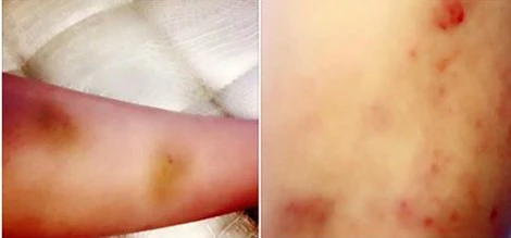 Hình ảnh thương tích mà nữ diễn viên chia sẻ trên trang cá nhân. c-d20fc-JPG.jpg