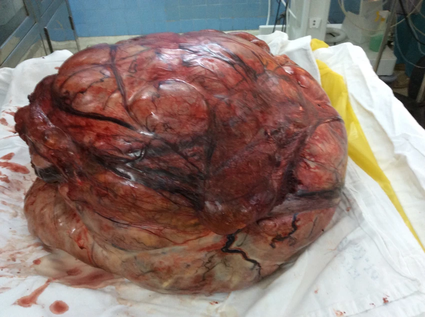 Cắt khối bướu tử cung nặng 26 kg ảnh 3 Cắt khối bướu tử cung nặng 26 kg ảnh 3