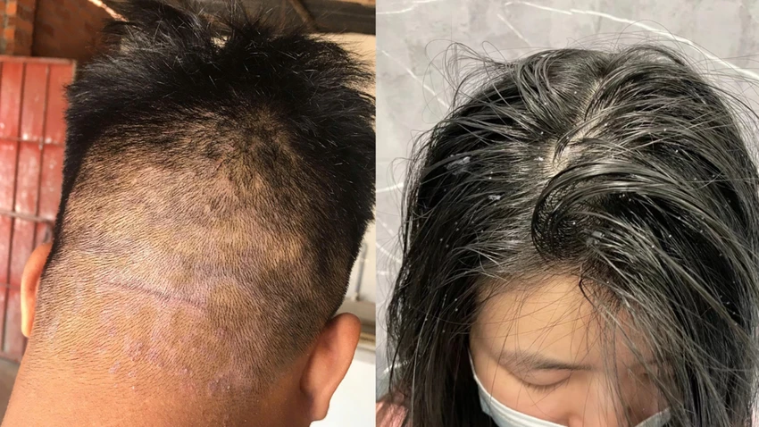 Tại sao mùa lạnh lại tăng sinh gàu – Hé lộ tips 'khắc phục' với chi phí thấp.png