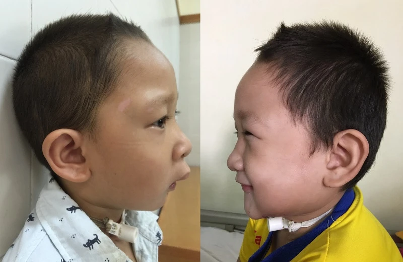 Trả lại gương mặt bình thường cho trẻ bị tật ảnh 1