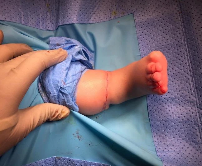 Chân phải con bà H trở lại bình thường sau khi phẫu thuật 