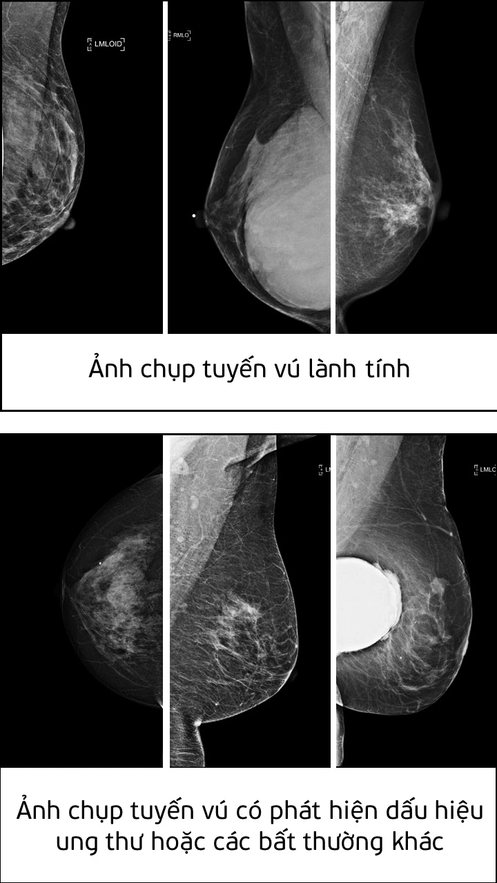 cong-nghe-ai-giup-phat-hien-ung-thu-vu công nghệ ai giúp phát hiện ung thư vú