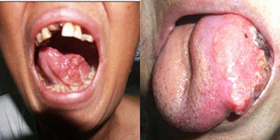 Loét lưỡi kéo dài nên nghĩ đến ung thư ảnh 1 Loét lưỡi kéo dài nên nghĩ đến ung thư ảnh 1