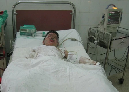 Nửa đêm đi cứu diều, bị điện cao thế phóng nguy kịch ảnh 1 Nửa đêm đi cứu diều, bị điện cao thế phóng nguy kịch ảnh 1