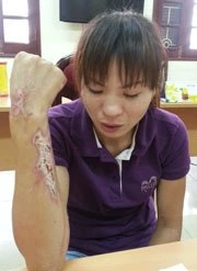 Hất xô axít vào chồng trong cơn cuồng ghen ảnh 1 Hất xô axít vào chồng trong cơn cuồng ghen ảnh 1
