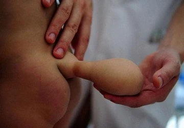 Bé trai 7 tháng tuổi có 'đuôi' ảnh 1 Bé trai 7 tháng tuổi có 'đuôi' ảnh 1