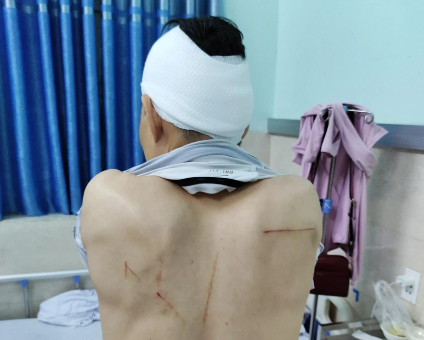 Do bị chém nhiều nhát vào đầu, lưng, tay và chân nên anh Hiệu phải chuyển lên Bệnh viện tuyến trên. Ảnh CTV Do bị chém nhiều nhát vào đầu, lưng, tay và chân nên anh Hiệu phải chuyển lên Bệnh viện tuyến trên. Ảnh CTV