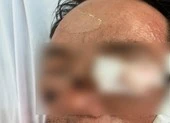 Đang ngồi nhậu bị pháo nổ trúng vào người phải cấp cứu