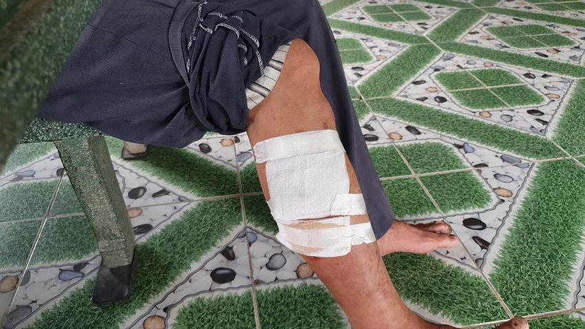 Trước đó, ông Cảnh bị con khỉ cắn vào chân, phải đi bệnh viện điều trị. Ảnh: NT Trước đó, ông Cảnh bị con khỉ cắn vào chân, phải đi bệnh viện điều trị. Ảnh: NT