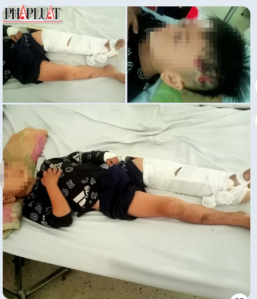 Theo gia đình, bé trai bị gãy xương chân, đầu xây xát. Ảnh: GĐCC Theo gia đình, bé trai bị gãy xương chân, đầu xây xát. Ảnh: GĐCC