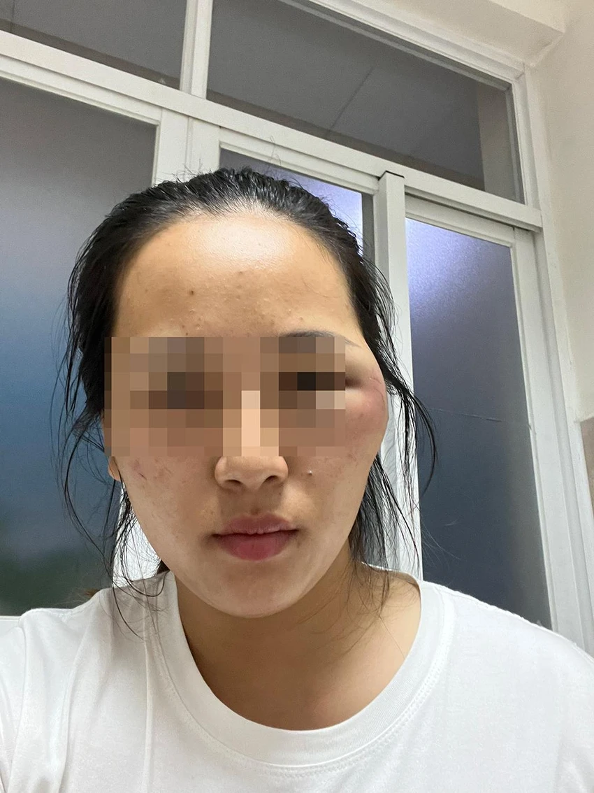 Chị L hiện vẫn đang được điều trị ở Bệnh viện Xuyên Á với vết bầm ở mặt, ảnh hưởng thị lực. Ảnh: HT Chị L hiện vẫn đang được điều trị ở Bệnh viện Xuyên Á với vết bầm ở mặt, ảnh hưởng thị lực. Ảnh: HT
