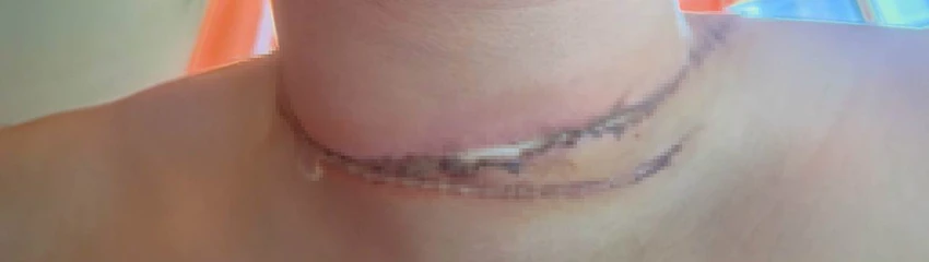 Cổ nạn nhân bị cắt sâu do vướng phải dây diều. Ảnh: ĐC Cổ nạn nhân bị cắt sâu do vướng phải dây diều. Ảnh: ĐC