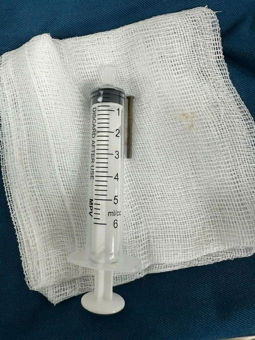 Gắp cây đinh sắt 3cm trong tá tràng bé trai 6 tuổi ở Quảng Ngãi