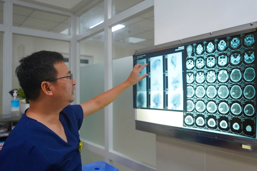 xuất huyết não