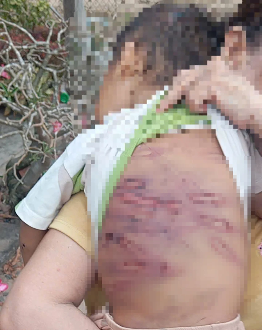 hinh-anh-vet-thuong-cua-chau-k-2-8356-9632.jpg