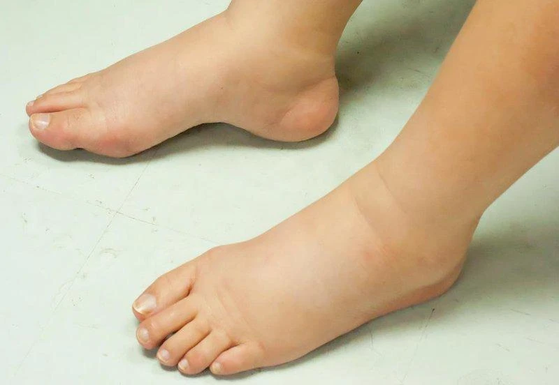 Hai trẻ nhập viện vì phù bất thường, phát hiện viêm cầu thận cấp
