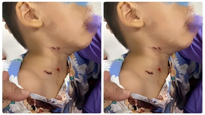 Bé trai 3 tuổi bị chó cắn vào cổ, gáy phải nhập viện