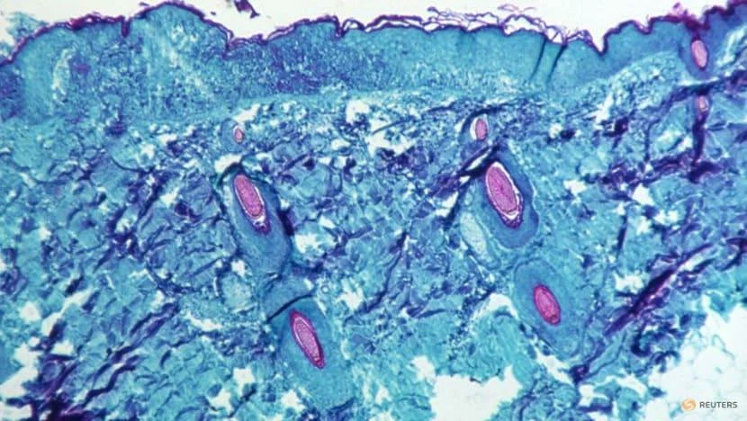 Một phần mô da được lấy từ vết thương trên da của một con khỉ bị nhiễm virus đậu mùa khỉ vào năm 1968. Ảnh: REUTERS Một phần mô da được lấy từ vết thương trên da của một con khỉ bị nhiễm virus đậu mùa khỉ vào năm 1968. Ảnh: REUTERS